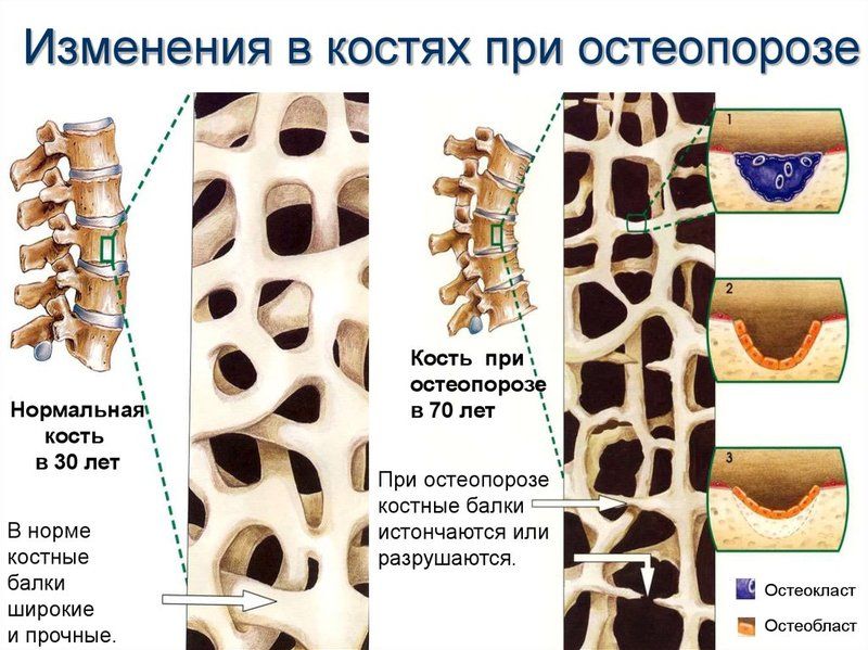 Przyczyny Osteoporozy Rodzaje I Objawy Choroby Metody Jej Leczenia I 24684 Hot Sex Picture 9775