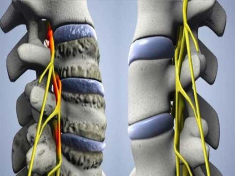 nekrovertebralna artroza grlića za liječenje vratne kralježnice