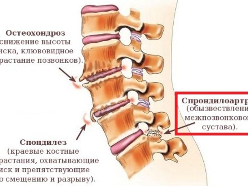 artroza vratne hrbtenice)