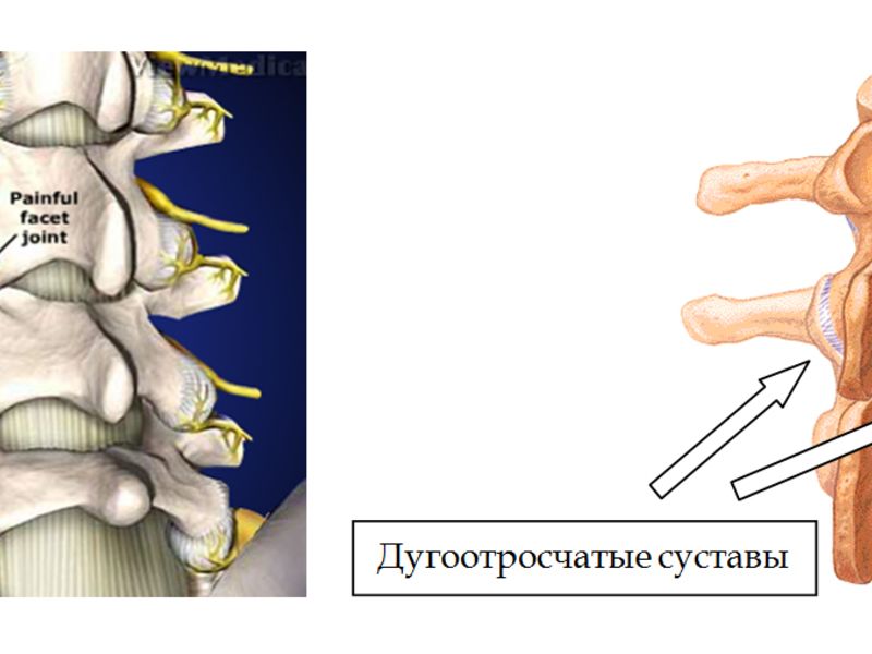 nekrovertebralna artroza liječenja cervikalne kralježnice c5- c6)