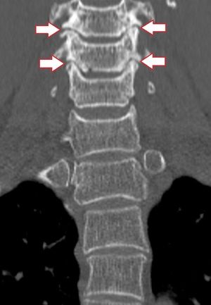 nekrovertebralna artroza grlića za liječenje vratne kralježnice