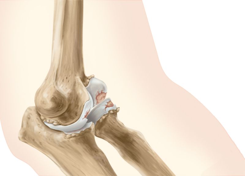 bol u zglobu koljena i kako liječiti bol u donjem dijelu leđa s artrozom koljena