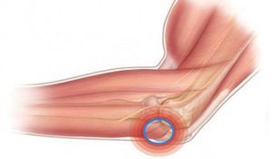deformirajuća artroza lakatnog zgloba liječenje 2 stupnja isprekidani bolovi u zglobovima