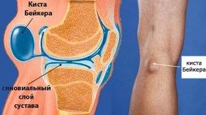 liječenje artroze vakuumskim bankama što razmazati od bolova u zglobovima