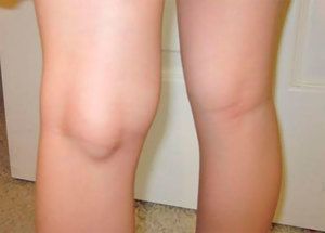 cista zgloba koljena i boli