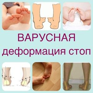 liječenje deformiteta nožne artroze)