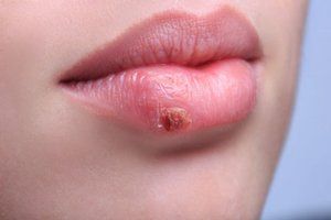 čirevi u ustima i bol u zglobovima s liječenjem artroze plazmoliftingom