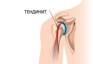 bol od ramena zajedničkih ligamenta)
