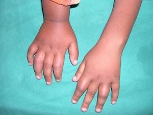 groznica i bolovi u zglobovima kod djece