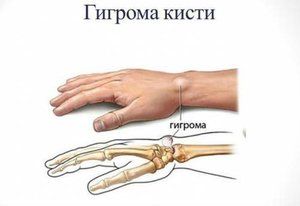 zglobovi u liječenju lijeve ruke bol gel joint