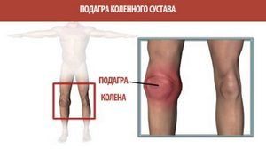 akutna bol u zglobu koljena