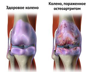 bol u zglobovima soli aparat za liječenje artritisa artroze cijena