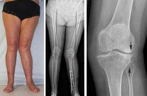 deformirajuća artroza uzrokuje liječenje