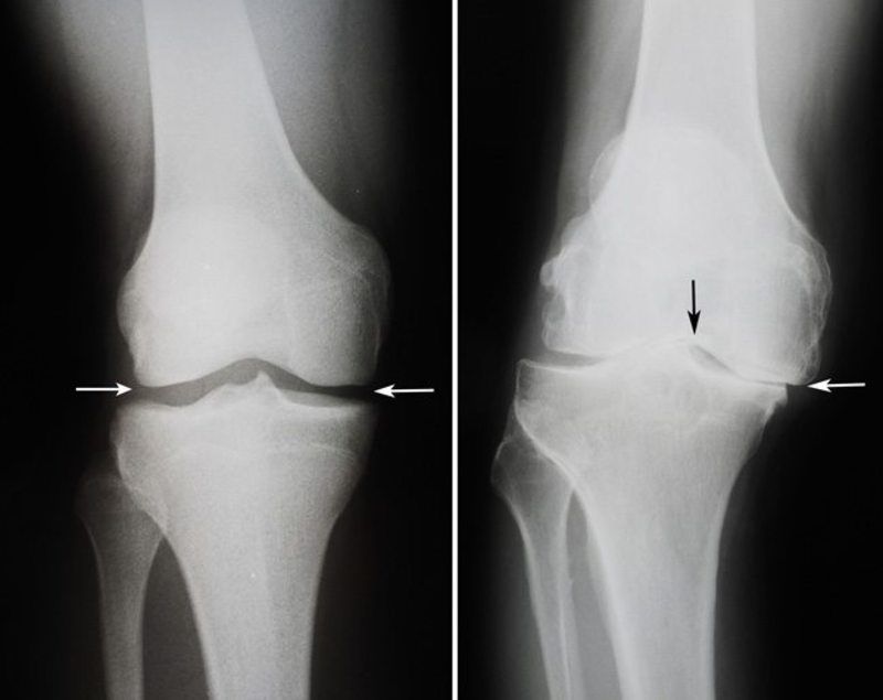 liječenje artritična zgloba koljena medicina bol u zglobovima kuka