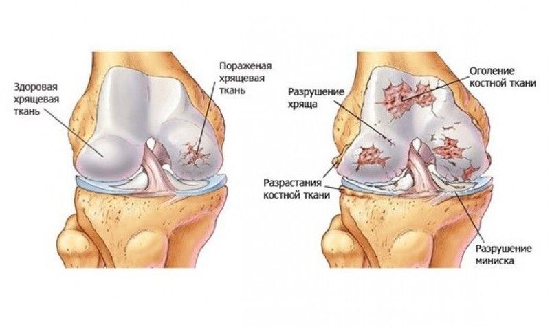 deformirajuća artroza liječenja metatarsofalangealnih zglobova)