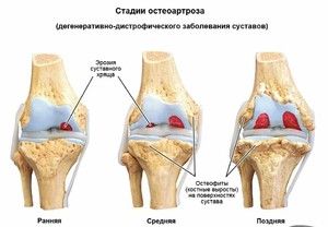 Osteoartritis koljena: liječenje i simptomi