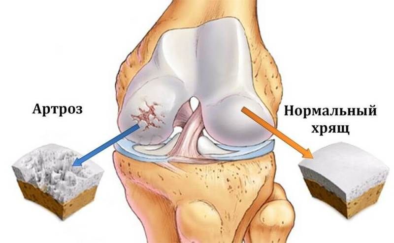 Znakovi i liječenje deformirajuće artroze koljena