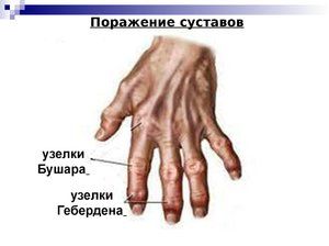 denas liječenje artroze)