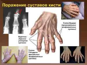 denas liječenje artroze)
