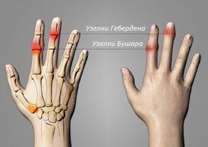deformirajuća artroza liječenja malih zglobova)
