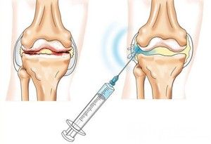 liječenje artroze koljena teraflexom kakvi su bolovi u zglobu kuka