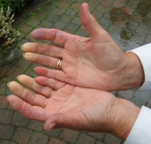 Bolovi u zglobovima prstiju šake: Uzrok, simptomi i kada morate doktoru?