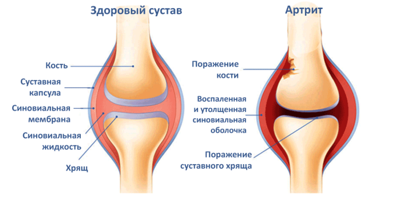 akutna bol s artritisom koljena