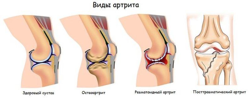 liječenje artritična zgloba koljena