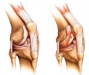artritis koljena akutna bol
