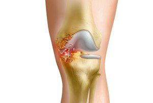 Mast za artritis koljena