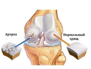 najbolji tretman za artrozu koljena)