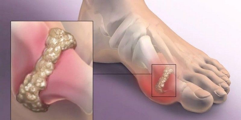 artroza prstov na nogah