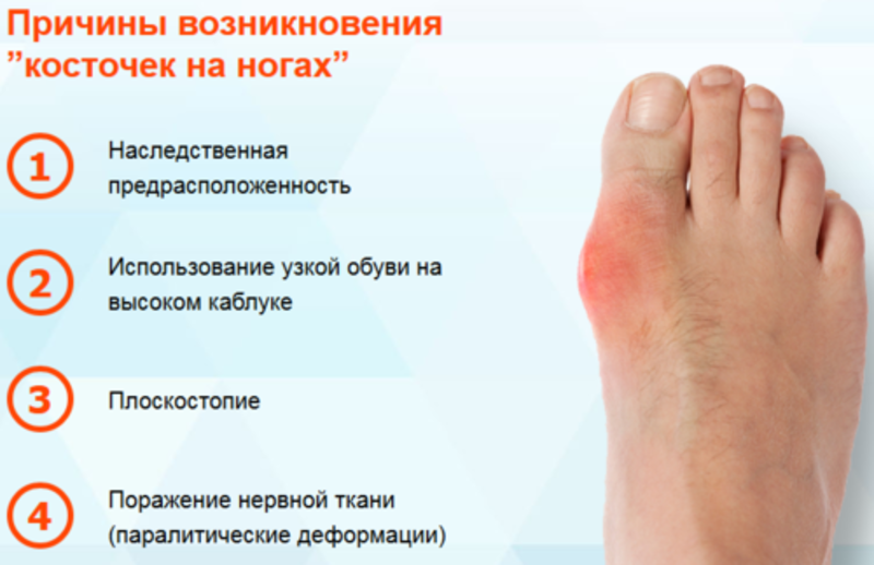 Artroza stopala: simptomi i liječenje