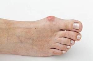 artroza 3 stupnja liječenja velikog nožnog prsta