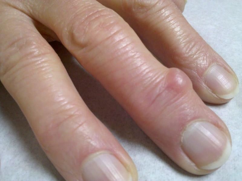cvorici na prstima ruke tratament cu artroză alflutop