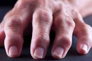 artritične prste oružja liječenje