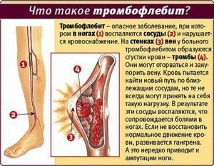 artroza žila donjih ekstremiteta liječenje simptoma liječenje osteoartritisa strane stopala i