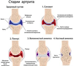 artritis matičnih stanica i liječenje artroze)