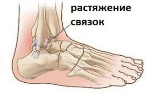bolovi u zglobovima s rupturom ligamenta gležnja)
