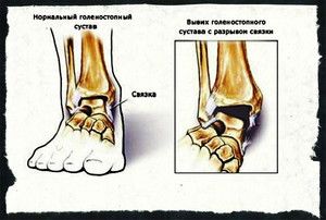 Tegobe stopala i gležnja - Javljanje na pregled