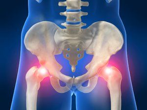 bol u koksartrozi kučnog zgloba prvi stupanj liječenja osteoartritisa