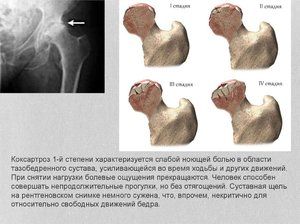 liječenje osteoartritisa s sinovitis noćna bol u liječenju zglobova kuka