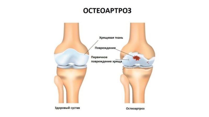 osteoartroza kolena umflarea articulației degetului după o tăietură