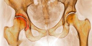 bol u koksartrozi kučnog zgloba pogoršanje u liječenju osteoartritisa