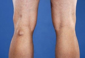 fizioterapeutski tretman artroze koljena