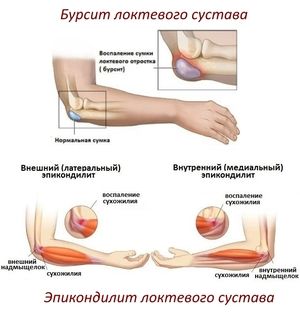 upala lakta u zglobu nova metoda liječenja artroze zgloba koljena