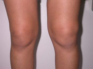 glina za liječenje artroze koljena