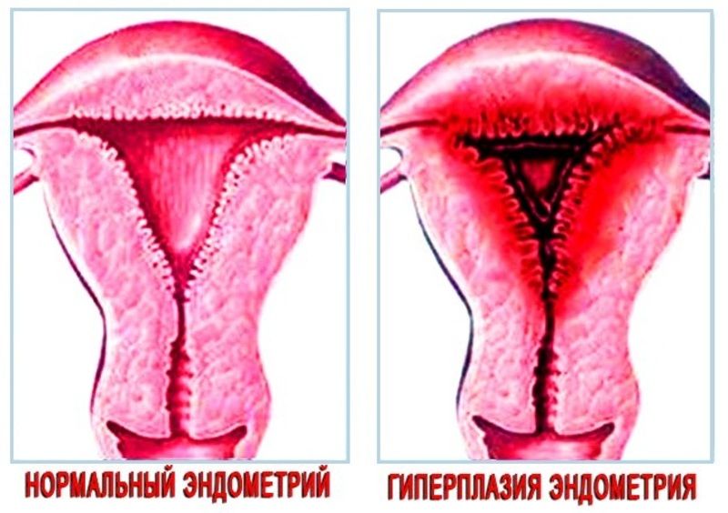 hipertenzija endometrij