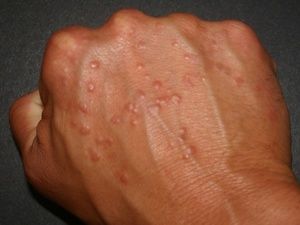 alergije na bol u zglobovima)
