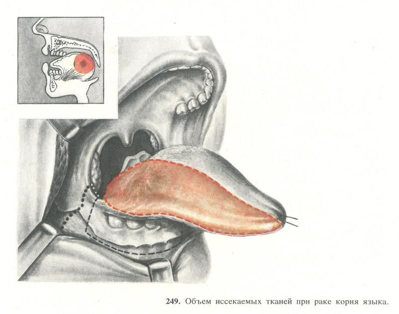 рак на езика снимки